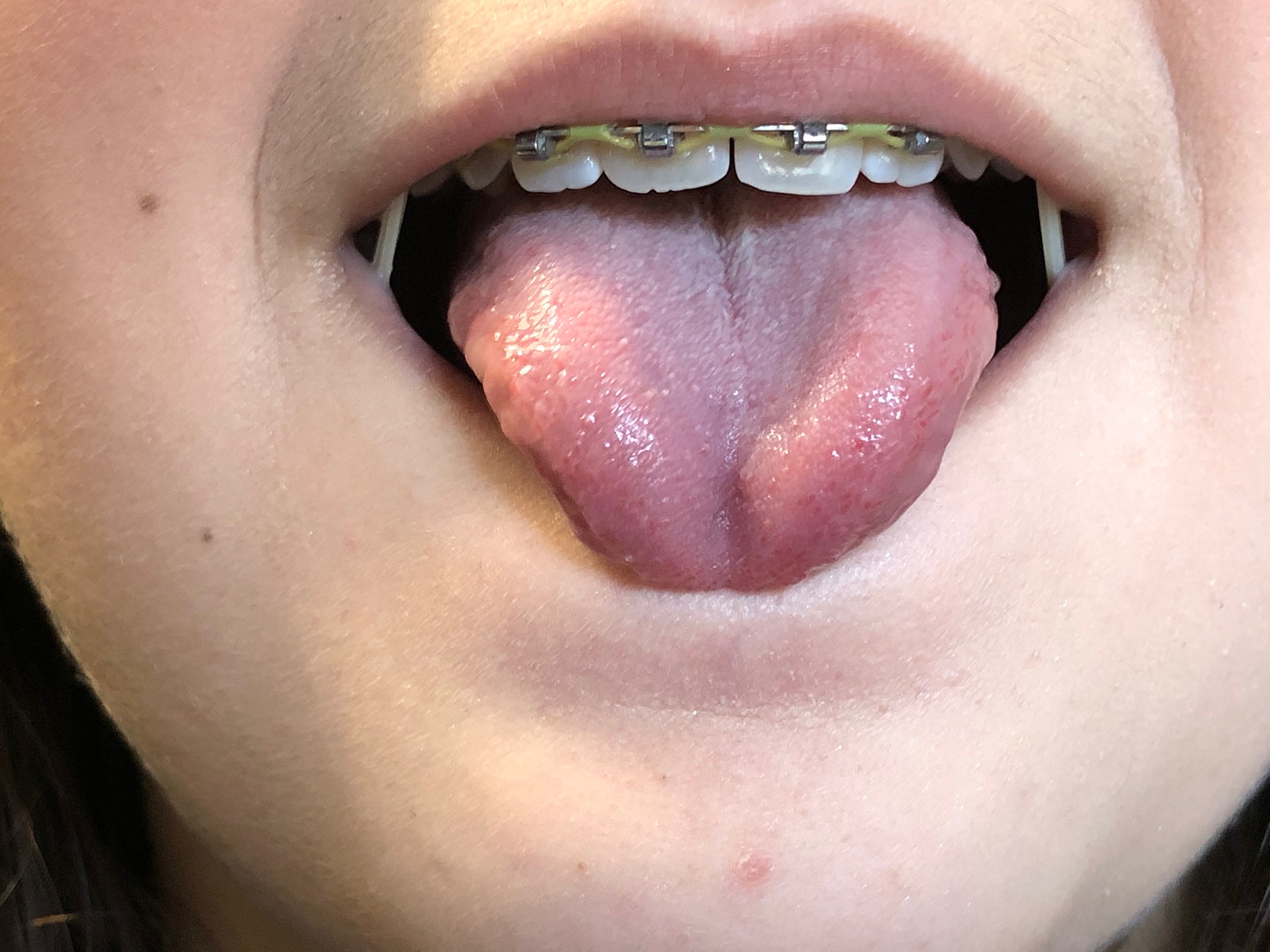 …und immer wieder das Zungenbändchen! SZETKonzept